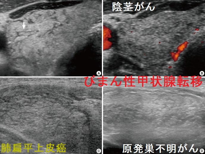 組織球性壊死性リンパ節炎の鍼灸【原因・定義・症状】 - 銀座そうぜん鍼灸院（深層筋・自律神経）銀座・築地