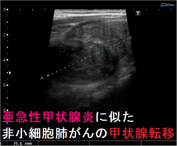 皮脂欠乏性湿疹およびうったい性皮膚炎