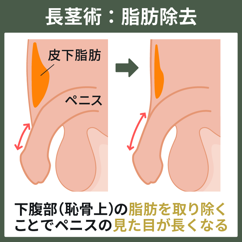 長茎手術（切らない・切る）-東郷美容形成外科 福岡メンズ-福岡・博多で包茎手術・亀頭増大・陰茎増大・長茎治療なら