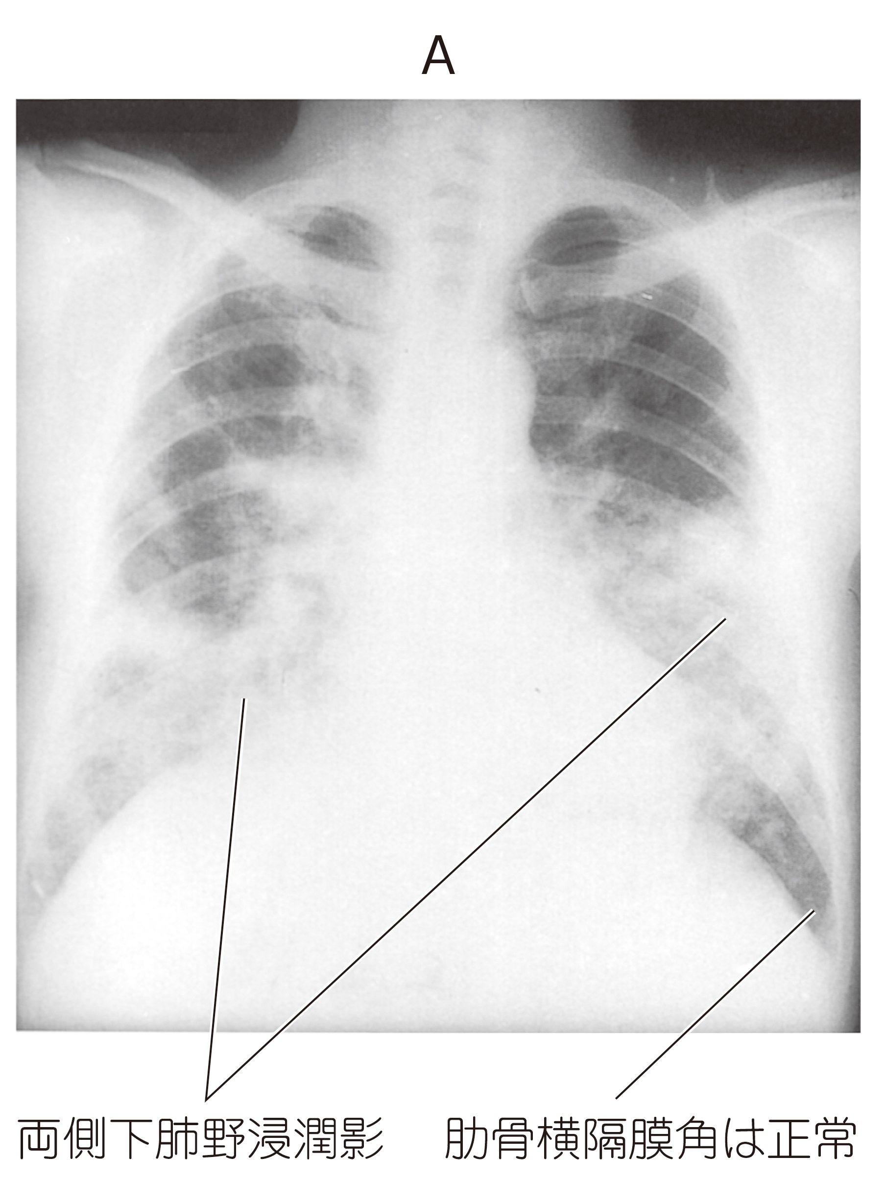 転移性甲状腺癌（他臓器癌が甲状腺に転移[橋本病 バセドウ病 超音波検査