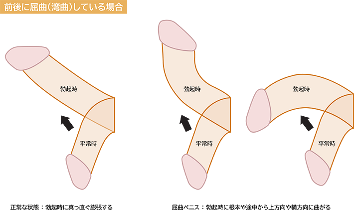 あなたは反りチン？上反り・下反りのメリットや女性の意見を紹介！｜駅ちか！風俗雑記帳