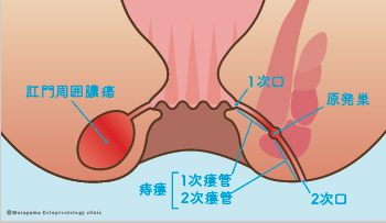 女性の肛門疾患｜大阪市住吉区あびこ駅前の肛門外科 むらやま大腸肛門クリニック