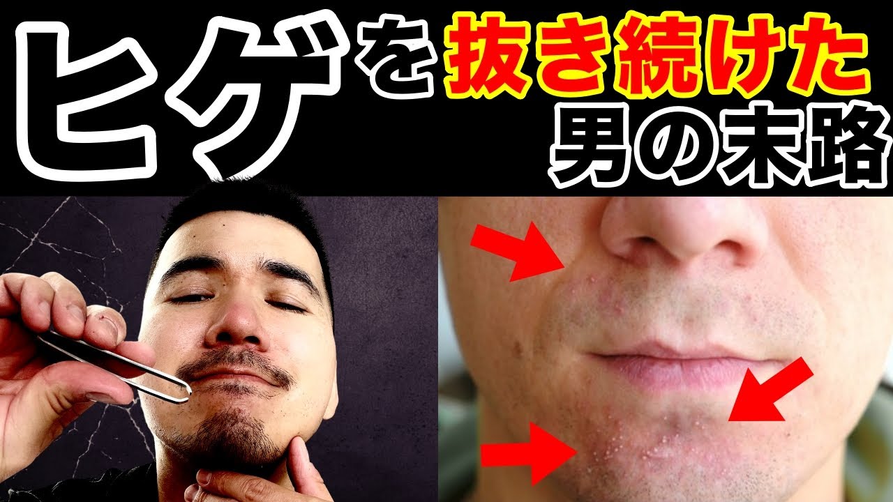 Plucking facial hair & ingrown