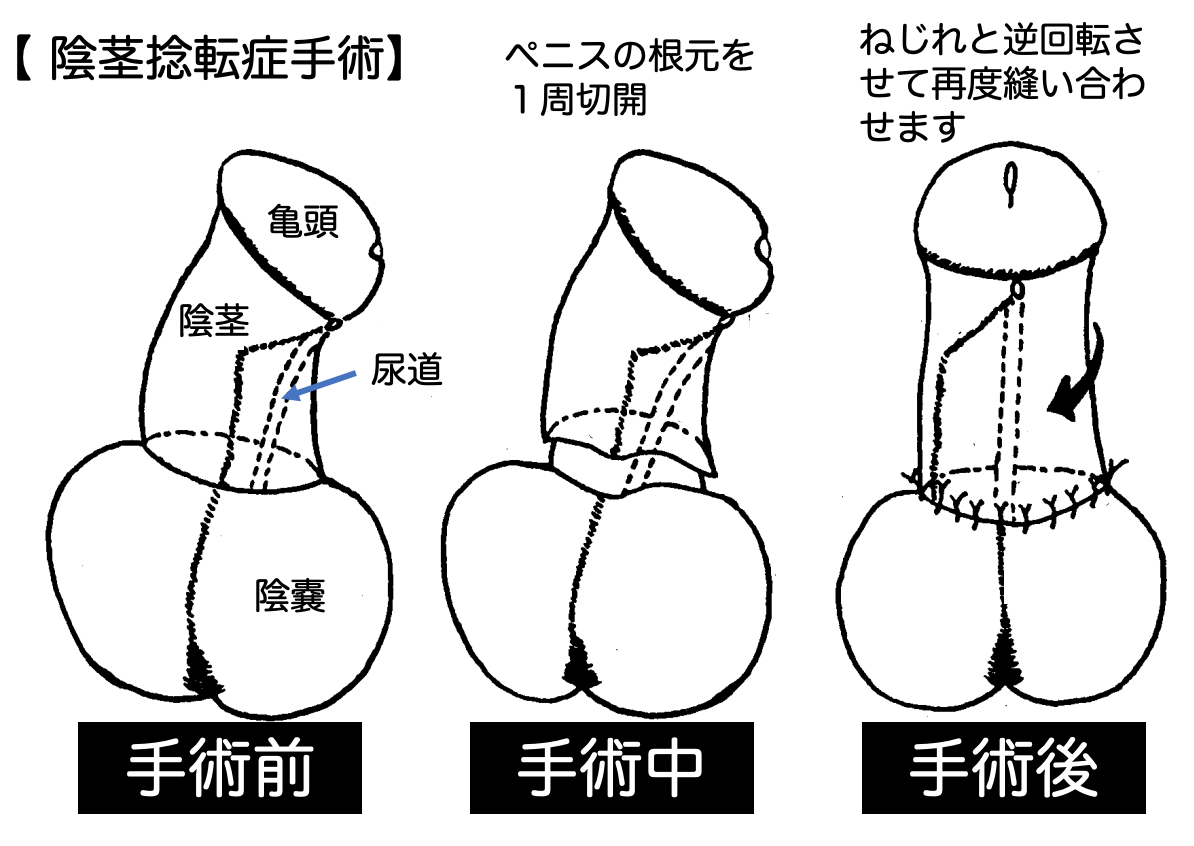 泌尿器科の専門医が徹底解説】ペニスの曲がりは治療が必要？原因・リスク・治療法まで