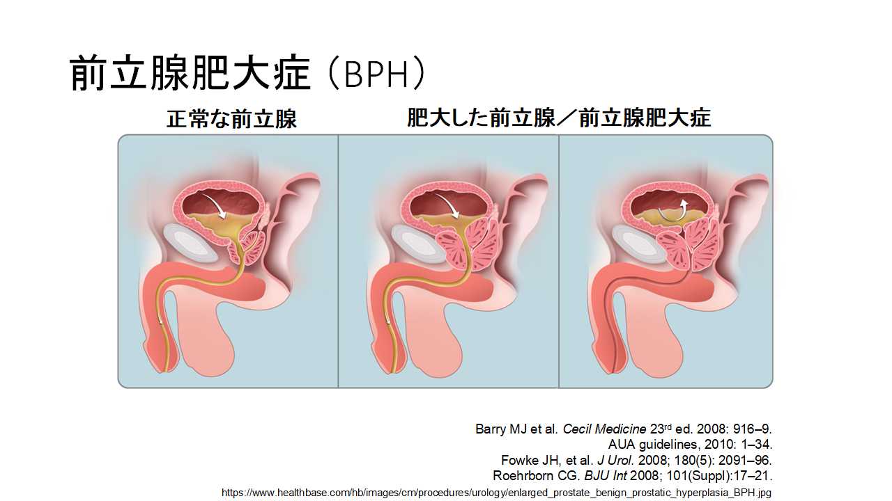 前立腺がん、治療に選択肢 ぼうこうに残ったがん細胞はどうする? | 毎日新聞