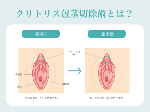 クリトリス包茎 | 婦人科形成