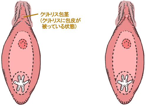 小陰唇、女性器の悩みなら | 浦和第一美容クリニック