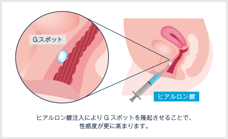 Gショット（不感症治療）の特徴と効果説明・女性医師の指名可能｜【公式】オザキクリニック（新宿・目黒祐天寺・羽村）