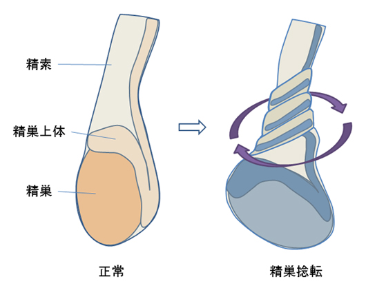 精巣腫瘍（精巣がん） - 泌尿器科の疾患- 東京八重洲クリニック