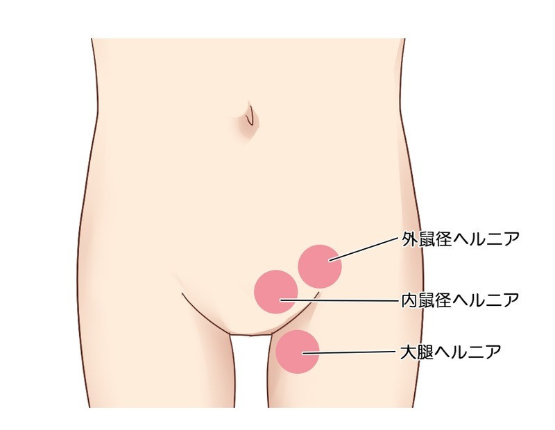 鼠径部痛症候群（グロインペイン症候群） ｜SPORTS MEDICINE