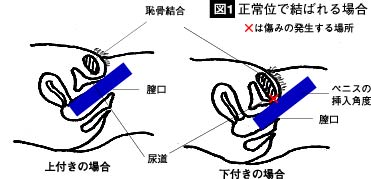 勃起の角度は何度が平均？低い原因や上向きにする方法を解説 |【公式】ユナイテッドクリニック