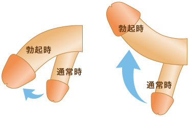 下向きになった男性器（ペニス）を上反りにする治療症例 | 症例写真・体験談｜包茎・ED治療など男性形成なら銀座みゆき通り美容外科 東京銀座・大阪梅田