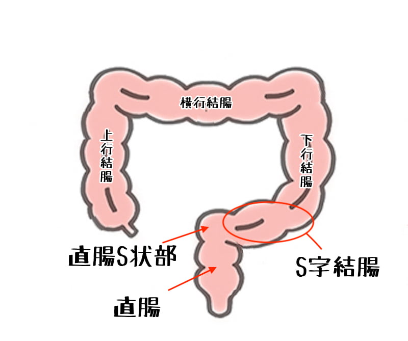 S状結腸軸捻転症｜オリンパス おなかの健康ドットコム