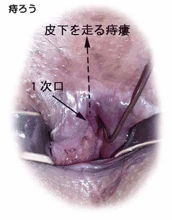 肛門のしまり | 大見クリニックの治療法