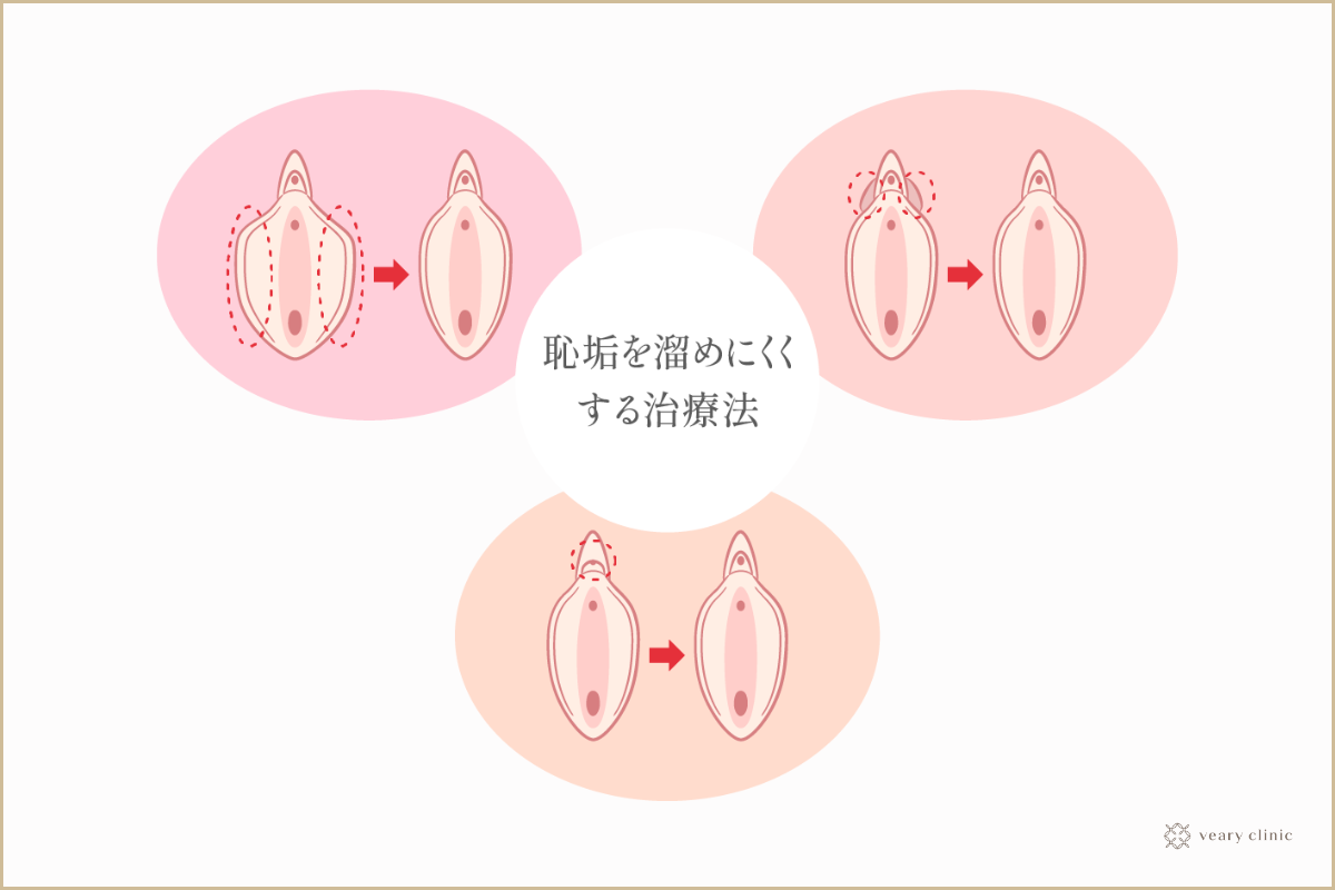 症例写真】クリトリス包茎の症例：美容外科 高須クリニック