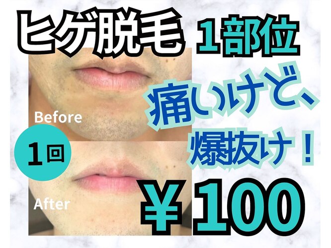 メンズぶっちゃけ体験談】ニードル脱毛で髭の永久脱毛！剛毛でもツルツルになった メンズリゼ神戸三宮(男性) - オトコロビューティー