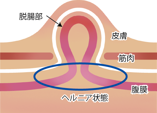 福岡市博多区の皮膚科「やまもと皮ふ科」 » イボについて①