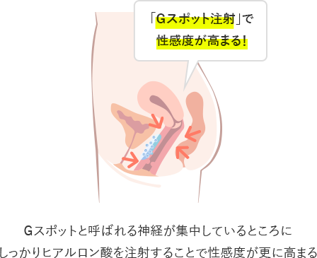 Gスポット注射｜銀座の美容外科・皮膚科ならルーチェクリニック