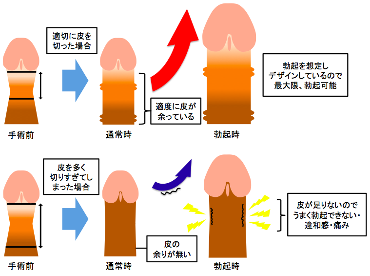 包茎手術 | 神戸中央クリニック・男性診療