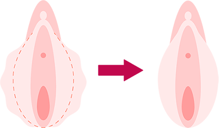 クリトリス包茎とは？悩みを解決する切除手術のメリットやリスクを解説 | コラム一覧｜  東京の婦人科形成・小陰唇縮小・婦人科形成（女性器形成）・包茎手術・膣ヒアルロン酸クリニック