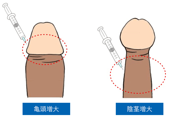 中学3年です。 勃起した時ちんこが 亀頭と根元は細く真ん中だけ太いの- その他（性の悩み） |