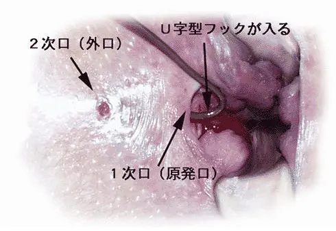 お尻のできもの(ぶつぶつ)はニキビ？原因と対処法|天神マイケアクリニック