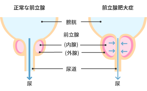 前立腺肥大症 | 杉並区 |