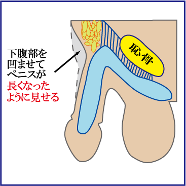 小さいペニス（短小）について - TENGAヘルスケア プロダクトサイト