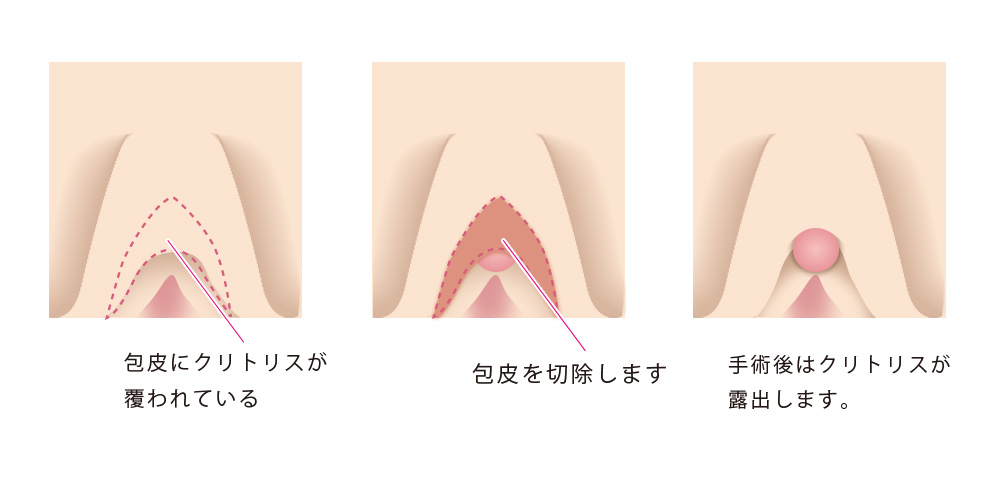 クリトリス包茎｜銀座みゆき通り美容外科大阪院