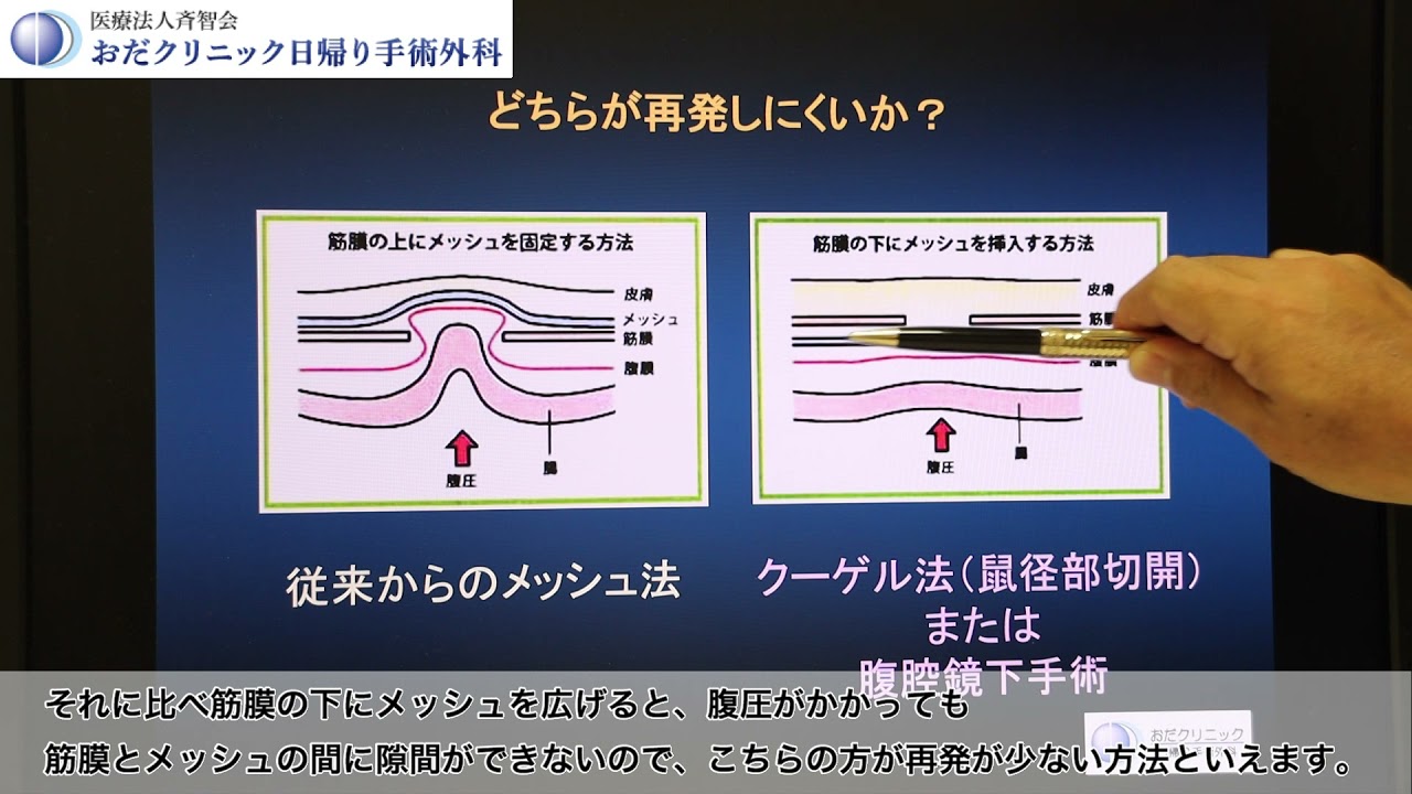 鼠径ヘルニア（脱腸）の見た目は？病気のサイン・初期症状を解説！