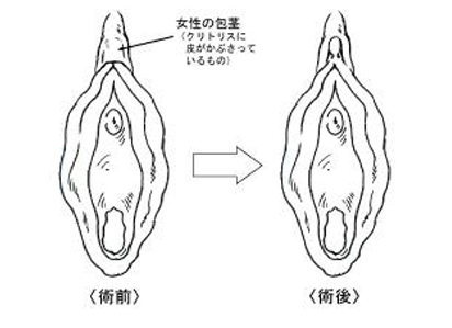 クリトリス包茎で叶える快適なインティメイトケア | ガーデンクリニック