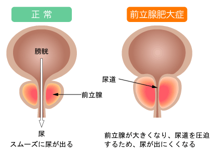 前立腺がん 全ページ：[国立がん研究センター がん情報サービス 一般の方へ]