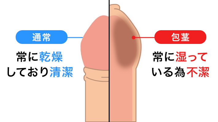 包茎の種類と特徴が知りたい。デメリットはありますか？【専門医が回答！男性の体Q&A③】 | yoi（ヨイ） -