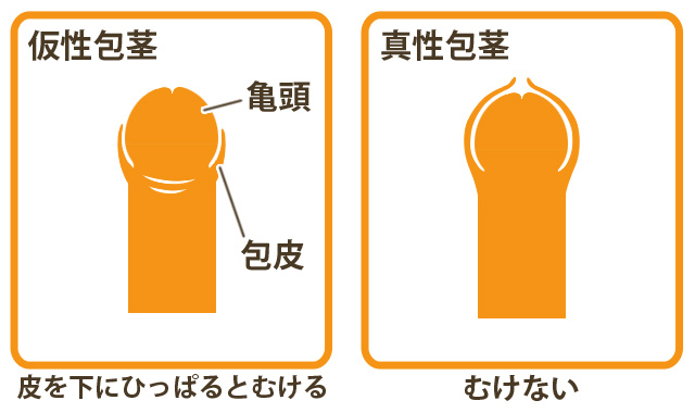 包茎でも風俗で遊べるの？疑問や遊ぶときのポイントも詳しく解説｜風じゃマガジン