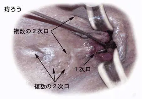 危機一髪】肛門を広げる手術後初の排便時に大変なことになった - 羽鳥商店