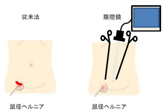 鼠径部(股関節)の痛み - 呉服町・博多駅東で整骨院をお探しならサンテ整骨院グループ