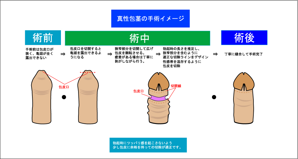 仮性包茎矯正リング 【カリバウアー ストロング