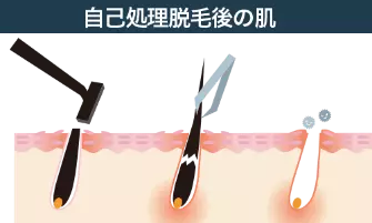 医師監修】「あごひげを抜くと生えてこない」は本当？デメリットや処理方法も解説 | Midashinami