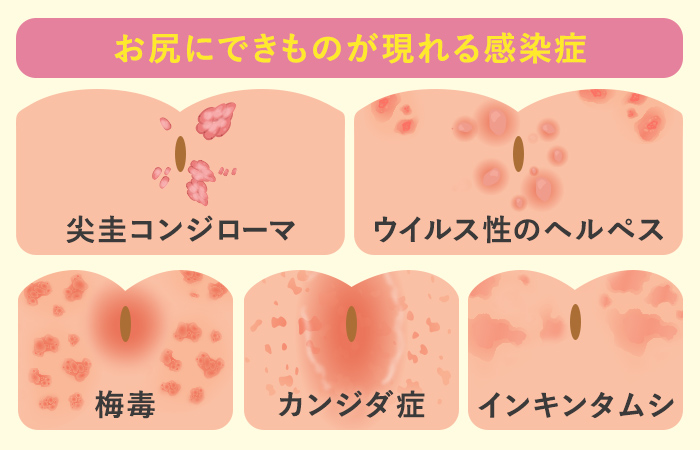 裂肛（切れ痔） | 岡外科胃腸肛門科