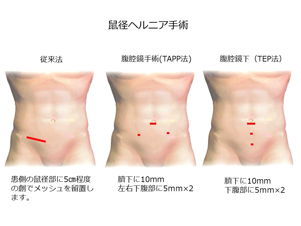 植木外科クリニック｜鼠径ヘルニア、痔の日帰り手術｜外科・胃腸科・肛門科・呼吸器科・消化器科｜福岡市