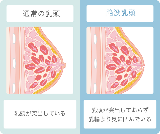 ED（勃起不全・勃起障害）｜坂泌尿科病院