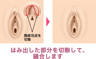 クリトリスの皮を剥くコツは？クリイキするための正しい剥き方をイラストでチェック