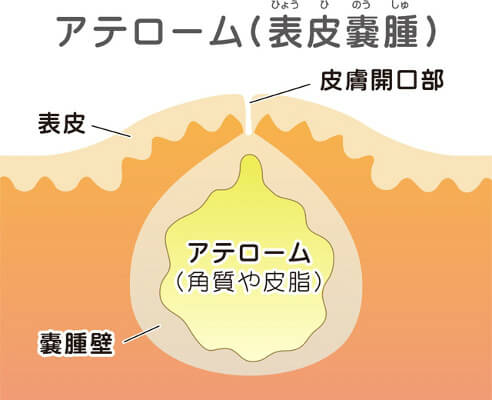 羽生市の鼠径ヘルニア（脱腸）の患者さんに当院が選ばれる理由とは？