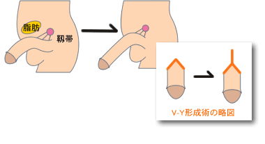 長茎治療 | かじクリニック熊本（メンズサイト）