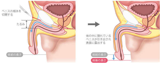 長茎術 | メンズライフクリニック【公式】