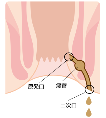 おしり(肛門)疾患説明｜大阪市住吉区あびこ駅前の肛門外科 むらやま大腸肛門クリニック