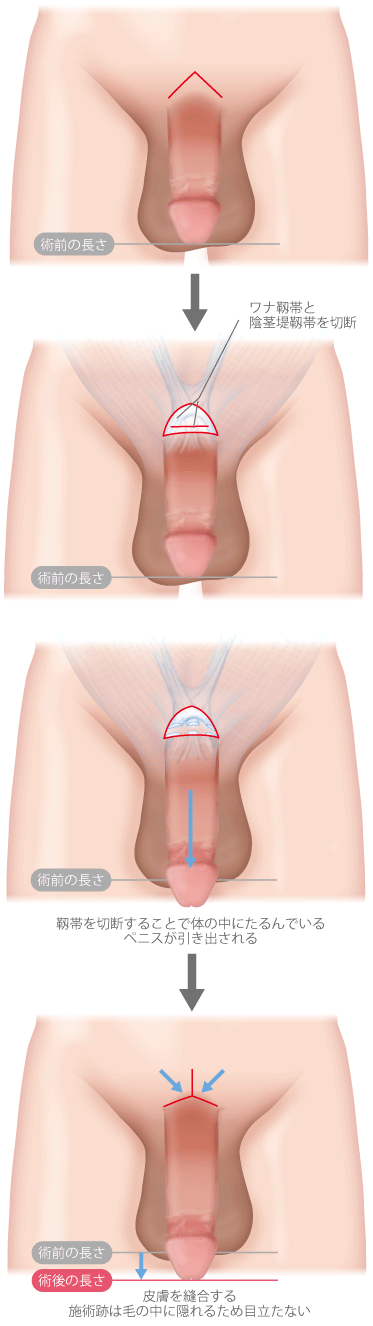 切らない長茎術 | ペニスを長くする方法とメリット |