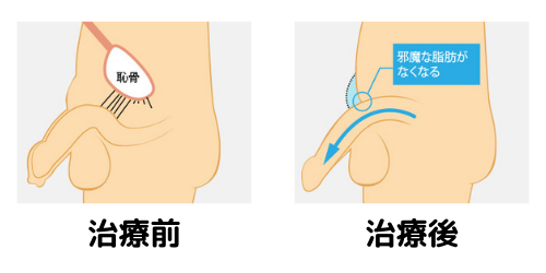 ペニスの構造と包茎の特徴｜包茎の手術や治療は認定専門医に！[東京・大阪]