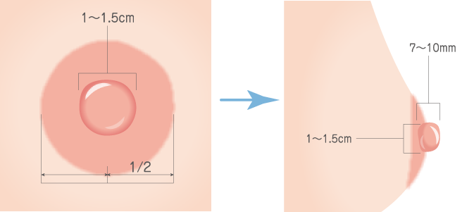 症例写真】乳輪縮小術 | 大阪のツツイ美容外科・美容皮膚科（心斎橋）