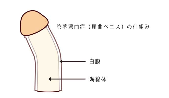 亀頭包皮炎 of おひげせんせいのこどもクリニック